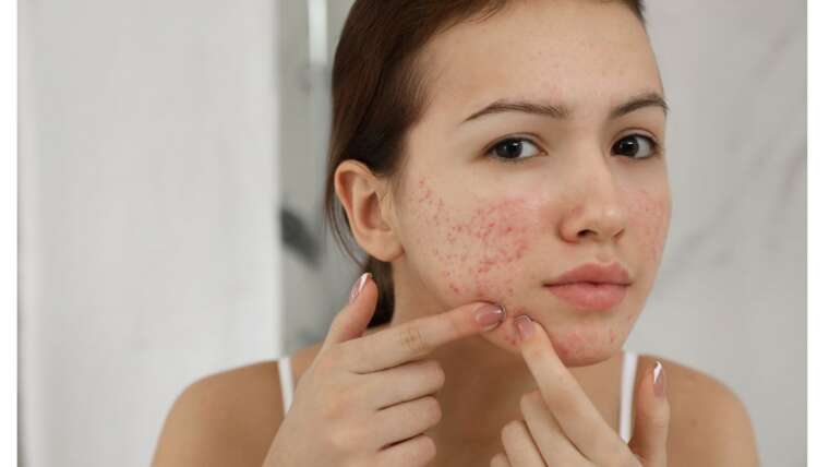 Vitamina C para espinha: combatendo a acne de dentro para fora